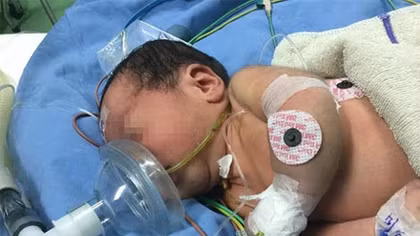 Cứu sống bệnh nhi 3 ngày tuổi bị teo thực quản hiếm gặp