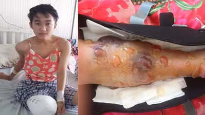 Họp hội đồng y khoa xác định nguyên nhân nữ sinh bị cưa chân