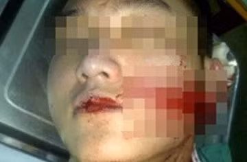  Cãi vã, dùng dao lam rạch mặt đối thủ