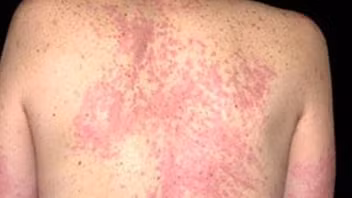 Dị ứng với nước, căn bệnh cực hiếm trên thế giới