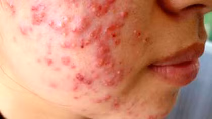 Cảnh giác với kem trộn trắng da cấp tốc