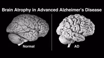 Bệnh Alzheimer lây truyền qua máu?