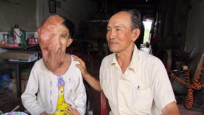 Nghị lực của cô bé bán vé số có khuôn mặt 'không dám nhìn'