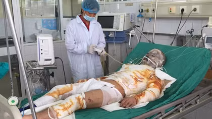 Vụ 6 người bỏng nhập viện - Nhiều khả năng do cháy nổ vì đào than thổ phỉ