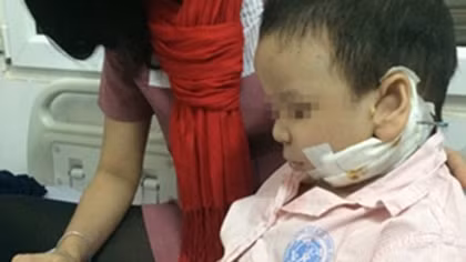 Thành công trong phẫu thuật kéo giãn xương hàm điều trị bệnh Pierre Robin cho trẻ