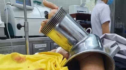 Người phụ nữ nhập viện với chiếc máy xay thịt "ngoạm" hết bàn tay