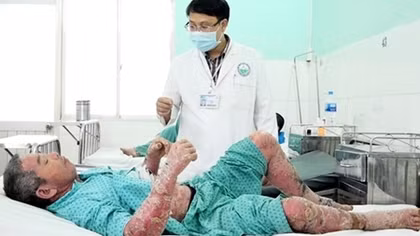 Toàn thân sưng vù, lở loét vì mua thuốc điều trị vảy nến trên mạng
