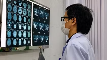 Phình động mạch não - Không thể coi thường