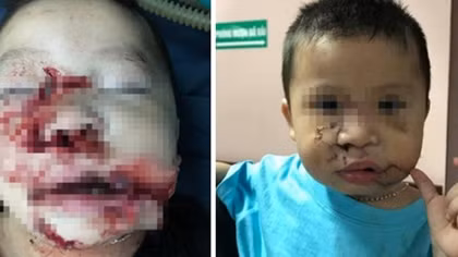 Tạo hình cho bé trai bị chó cắn nát mặt