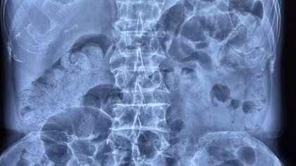 Lần đầu tiên thực hiện thành công đặt stent điều trị ung thư đại trực tràng tại phía Nam