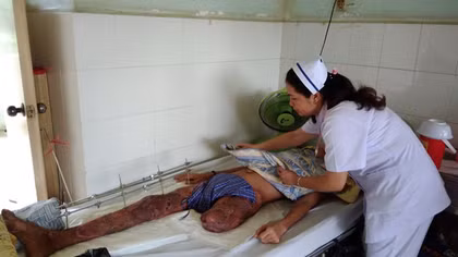 Thương cảm nam thanh niên 18 tuổi mất chân vì tai nạn lao động