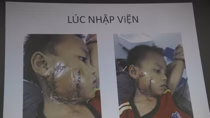Lấy lại khuôn mặt cho bệnh nhi bị cánh quạt công nghiệp "chém nát"