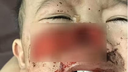 Hãi hùng bé trai bị chó cắn đứt rời... mũi