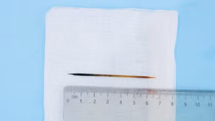 Ngủ quên, người đàn ông nuốt phải chiếc tăm dài 7 cm