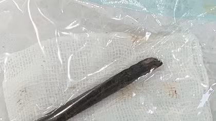 Khúc đũa 7 cm bị "bỏ quên" trong hốc mũi bệnh nhân suốt 4 năm