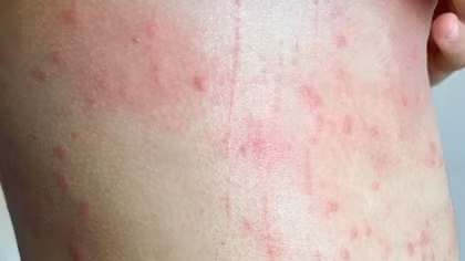 Nhiều du khách than ngứa khi tắm biển Đà Nẵng 