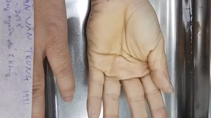  Ghép nối thành công bàn tay bị đứt lìa cho bệnh nhân 