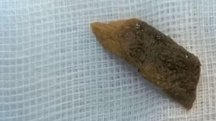 Sống chung với mảnh xương heo dài gần 1cm găm trong phổi suốt hơn 1 năm