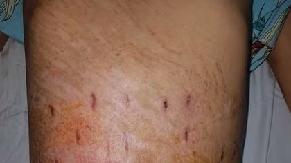 Cứu sống cô gái bị xe tải trộn bê tông cán ngang người