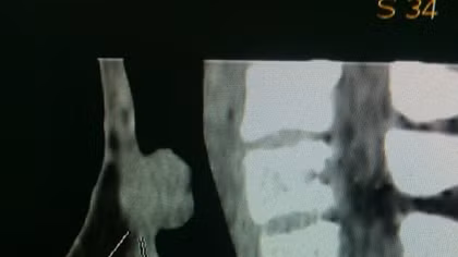 Lần đầu tiên phẫu thuật thành công cắt nối khí quản cho bệnh nhân 