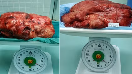 Hai bệnh nhân may mắn "bứng"được khỏi ổ bụng những khối bướu "khủng"