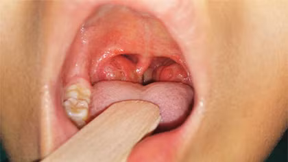 Một HS được điều trị cách ly do nghi mắc bệnh bạch hầu