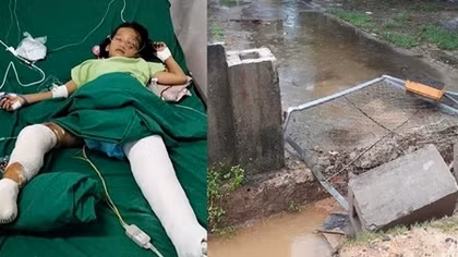 Cháu bé gãy cả hai chân vì cổng nhà văn hóa xóm đổ 