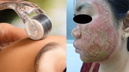 Tai biến do làm đẹp bằng phương pháp lăn kim