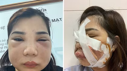 "Vỡ mặt" vì… làm đẹp trừ nợ