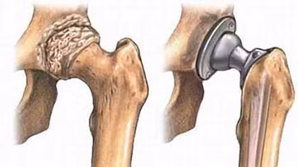 Thay khớp háng nhân tạo thành công cho bệnh nhân 100 tuổi