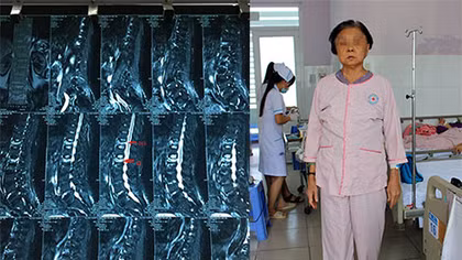 Cụ bà 69 tuổi thoát cảnh liệt giường nhờ kỹ thuật “đổ” xi măng cột sống