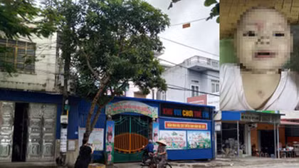 Cháu bé 14 tháng tuổi đầy thương tích sau ngày đầu đi học