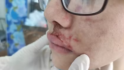 Mặt sưng phù, mưng mủ do tiêm filler làm đầy rãnh má