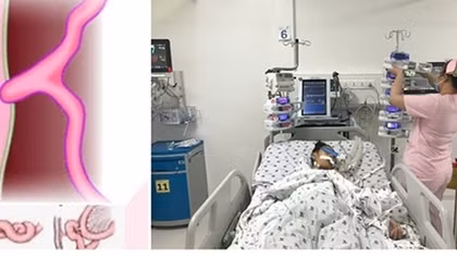 Cấp cứu bệnh nhi thoát vị nội hiếm gặp