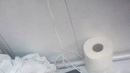 Phẫu thuật đặt stent cho bệnh nhi đầu tiên bị thủng thực quản
