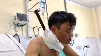 Cứu sống công nhân bị thanh sắt đâm xuyên từ cổ xuống ngực
