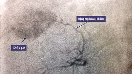 Trị ung thư gan nhờ “khóa” mạch máu nuôi khối u ác tính 