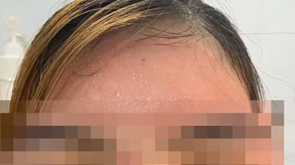 Mặt sưng phù sau khi đắp “mặt nạ” làm trắng da