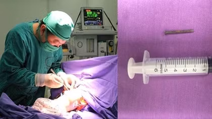 {HY HỮU} Một em bé nuốt phải chiếc đinh sắt dài 3cm
