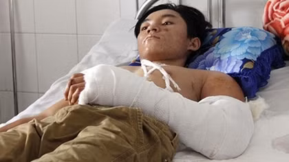 Một thanh niên bị quạt hút lúa chém nát cánh tay