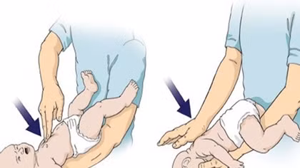 Bé trai 21 ngày tuổi tử vong do ngạt sữa