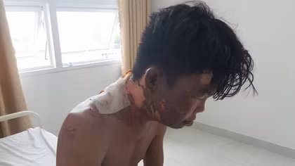 Chị gái đổ nồi nước sôi lên người em trai