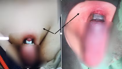 Nghịch dại suýt rụng “của quý”