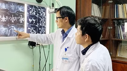 5% người Việt mắc phình động mạch não