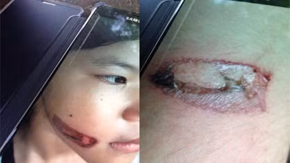 Bé gái bị bạo hành bằng sắt nung đỏ dí vào hai cánh tay