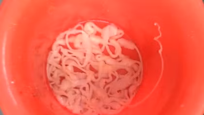 Hãi hùng sán xơ mít dài 9m trong bụng nam thanh niên
