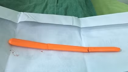 Cứu sống bệnh nhân tự lấy muỗng đâm vào hốc mắt xuyên sọ