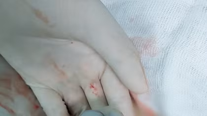 Những hiểm nguy khi dây rốn thắt nút