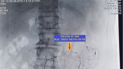 Lần đầu tiên can thiệp ung thư gan di căn bằng nút động mạch hóa chất 