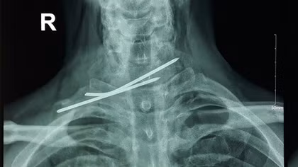 (NÓNG) Người đàn ông bị đinh đâm xuyên thực quản, khí quản 